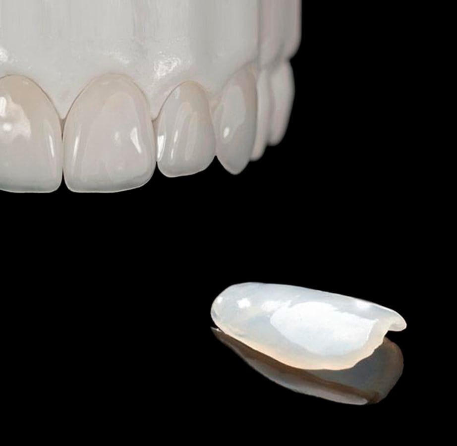 tipos carillas dentales torremolinos